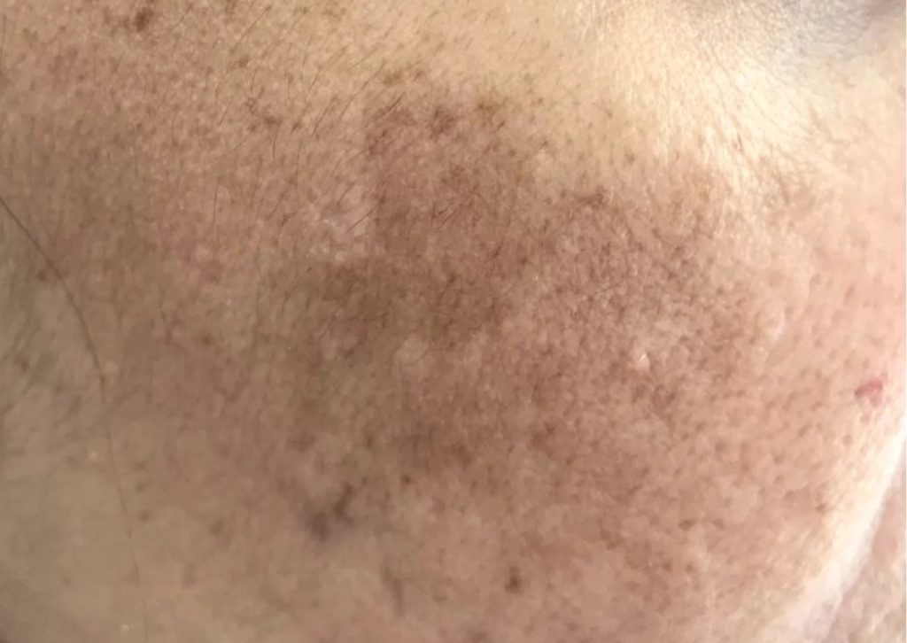 Tretman uklanjanja tamnih fleka u kozmetičkom salonu